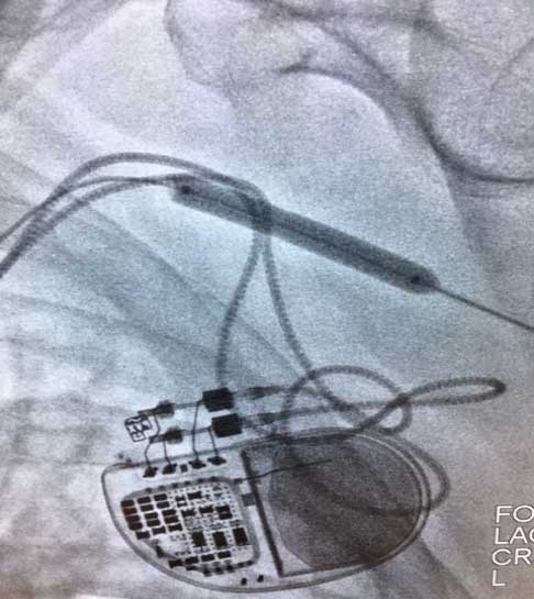 Figure 3. Fully inflated balloon resulting in the stenosis yielding