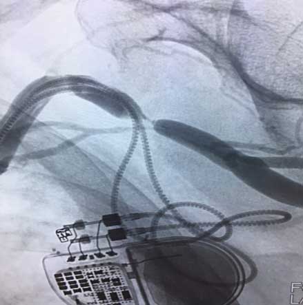 Figure 1. High grade stenosis of the left cephalic vein
