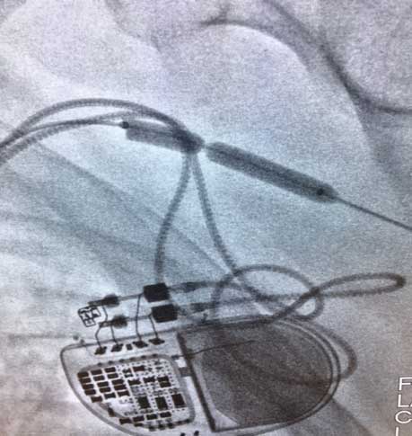 Figure 2. Highly resistant lesion despite high atmospheric balloon pressure