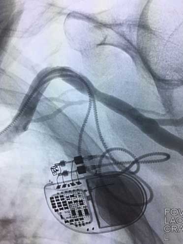 Figure 4. Successful drug coates balloon angioplasty result